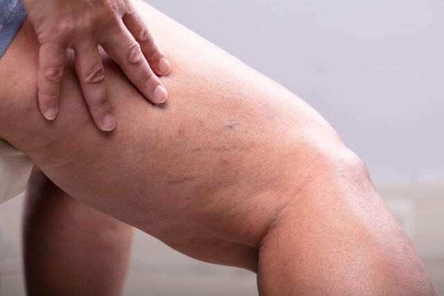 '지방흡입술, 지방부종 환자 10명 중 7명 통증 완화 효과 입증'