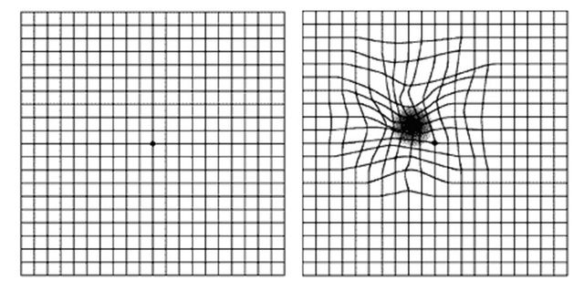 암슬러 격자 자가진단 시 선이 휘어져 보이거나, 중심부위 암점 등의 증상이 나타나면 황반변성을 의심해볼 수 있다. [사진=김안과병원]
