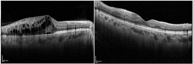 항혈관내피성장인자 항체 주사치료 전(왼쪽)과 항혈관내피성장인자 항체 주사치료 후 황반부종이 호전된 소견. [사진=김안과병원]