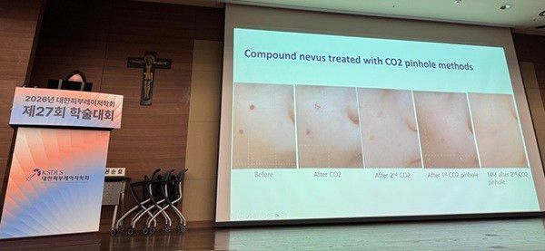 나정임 교수는 성인과 다른 소아 색소질환의 특성과 병변별로 다른 레이저 치료법에 대해 자세히 설명했다.&nbsp;사진은 핀홀 방식의 CO₂레이저를 활용해 치료를 진행한 환자 사례.&nbsp;