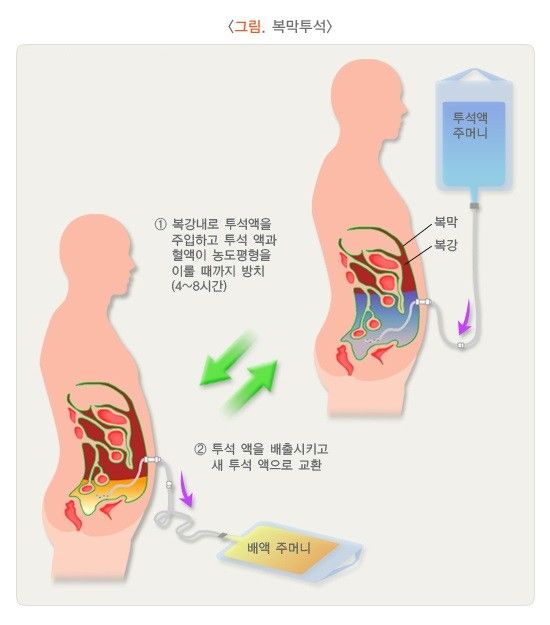 복막투석 방법(사진=질병관리청)