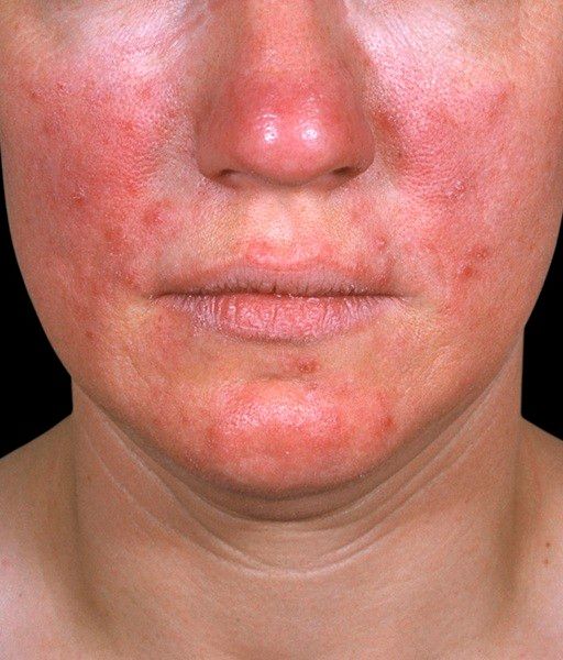 홍조가 쉽게 가라앉지 않거나 화끈거리는 증상이 지속되고 반복된다면 피부질환 ‘주사’를 의심해야 한다(사진=클립아트코리아).