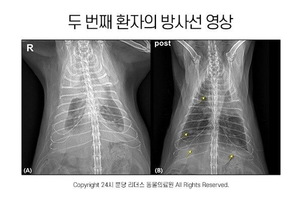 (A) 방문 당시 흉부방사선 영상. (B) 흉수 천자 이후 흉부방사선 영상. 폐야에 결절(노란 화살표) 다수 확인되어 전이 의심됨.
