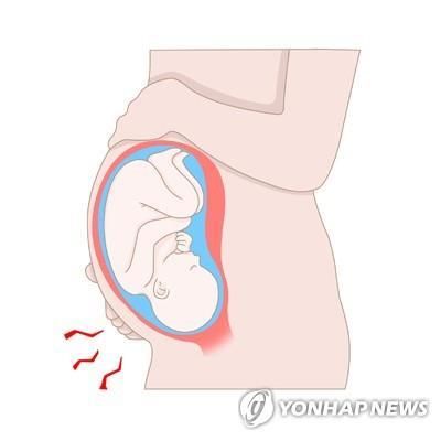조산