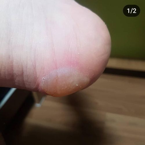 침낭 속에 넣어둔 핫팩에 의해 2도 화상을 입은 한 캠퍼 [독자 장환철 씨 제공] 