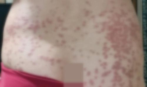 몸에 두드러기가 생긴 모습