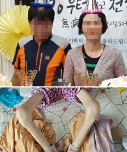 A씨의 건강할 때(위) 모습과 병원 시술 후 음식을 먹지 못해 뼈만 남은 상태(아래).