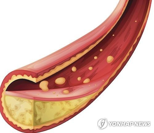혈중 콜레스테롤(일러스트)