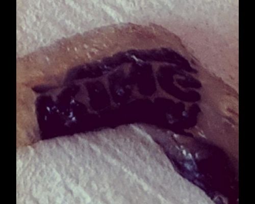 버거킹 햄버거 고기 패티에서 나온 이물질