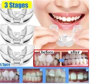 무허가 투명치아교정장치 해외직구 광고 사례 [식품의약품안전처 제공]
