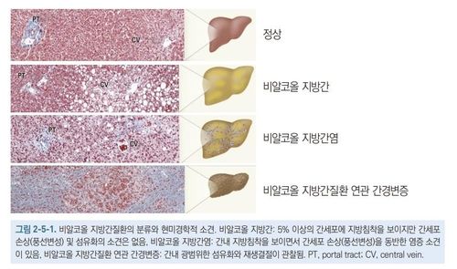 비알코올 지방간 질환의 분류