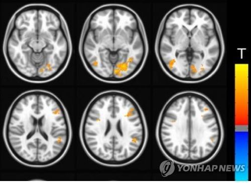 윗줄이 뇌의 앞쪽인 전두엽, 아래 줄이 뇌의 측면인 두정엽 부위