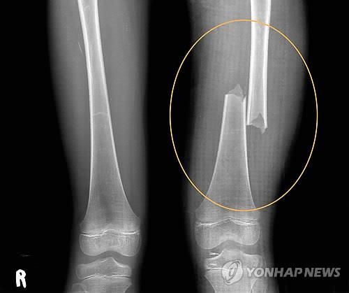 계모 학대로 허벅지 뼈가 두 동강 난 서현이 사진