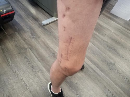 현직 전투 보병의 상흔