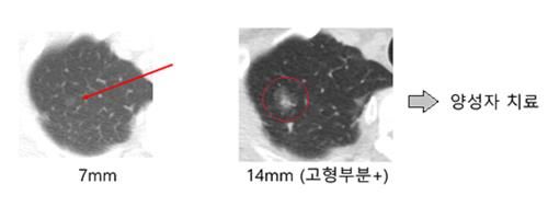 2002년 CT 검사에서 발견된 결절(왼쪽)과 133개월 후 크기가 커진 결절