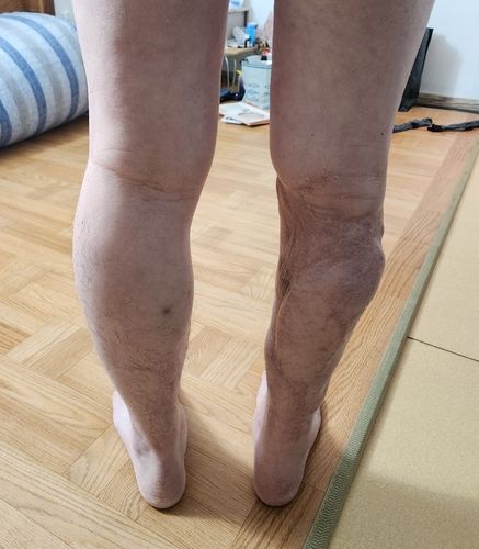 사건 이후 A씨의 다리 상태