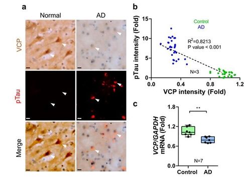 알츠하이머병 환자 뇌에서 발로신 함유 단백질(VCP)이 줄어든 모습
