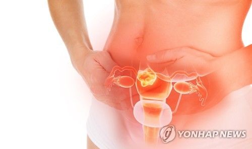 난소암 