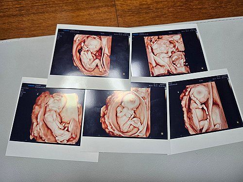 서울성모병원서 다섯쌍둥이 탄생