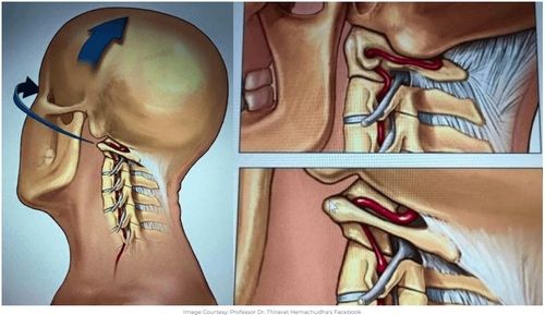 격렬한 목 마사지 시 목 혈관·신경 손상 우려