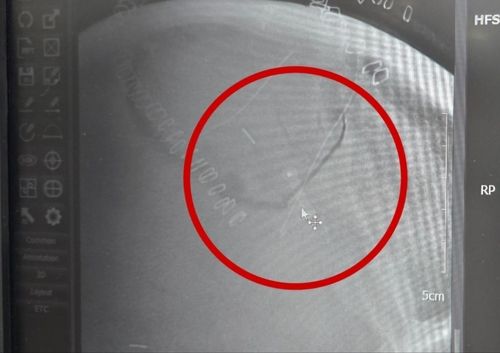 머리뼈에 박힌 톱날