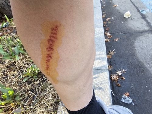 부상 당한 박씨의 다리