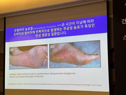 손발바닥 농포증 증상