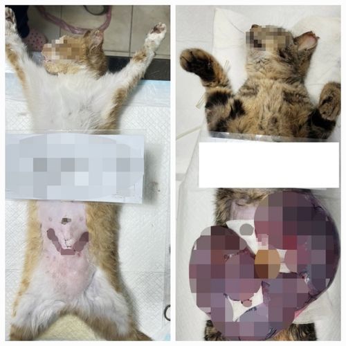 적출된 자궁의 크기 차이