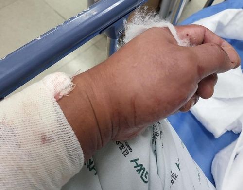 조명등 유리 떨어져 중상