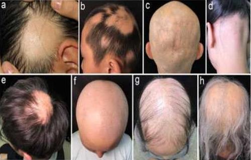 다양한 형태의 원형 탈모