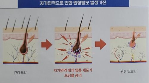[대한모발학회 제공]