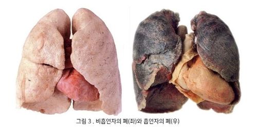 비흡연자의 폐와 흡연자의 폐