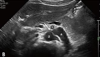 호두까기증후군