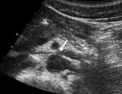 호두까기증후군