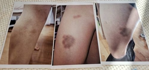 A군의 허벅지에 든 멍 자국