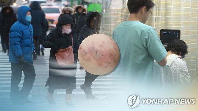 면역력 떨어진 틈 노리는 대상포진(CG)
