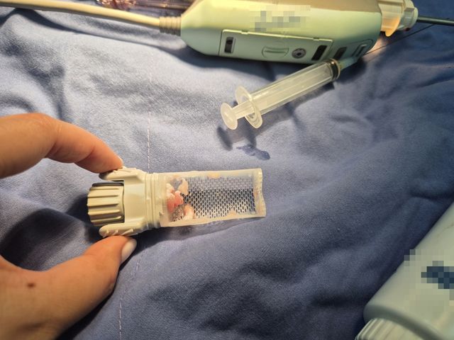 종양 제거 수술 시연 장면