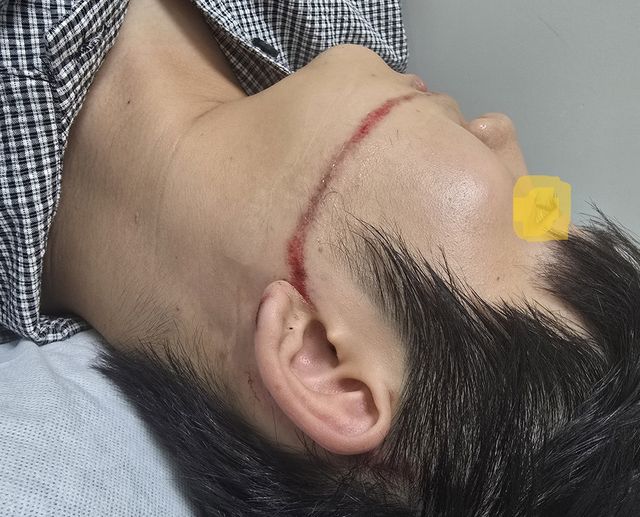 안산시 물축제에서 워터건에 맞아 다친 피해자