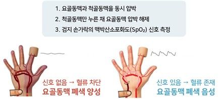 영유아 요골동맥 폐색 검사법