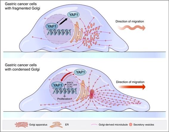 (서울=연합뉴스) 위암 세포 내 골지체의 응축된 구조 변형이 암 촉진 인자인 YAP1을 활성화해 암의 악성화를 유도하는 과정을 설명하는 모식도. 2025.11.11. [가톨릭중앙의료원 제공. 재판매 및 DB 금지]