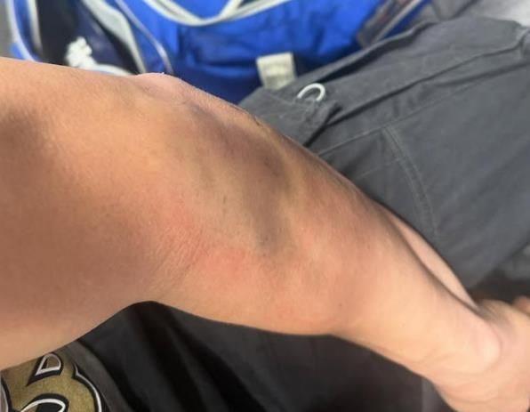 월드시리즈 당시 에르난데스의 팔꿈치 상태