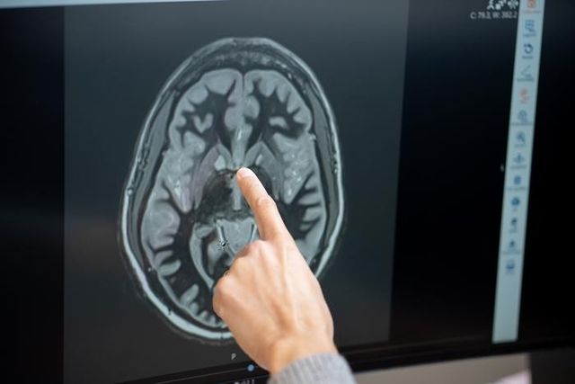 당뇨·비만 환자의 뇌 CT 영상 측좌핵 부분