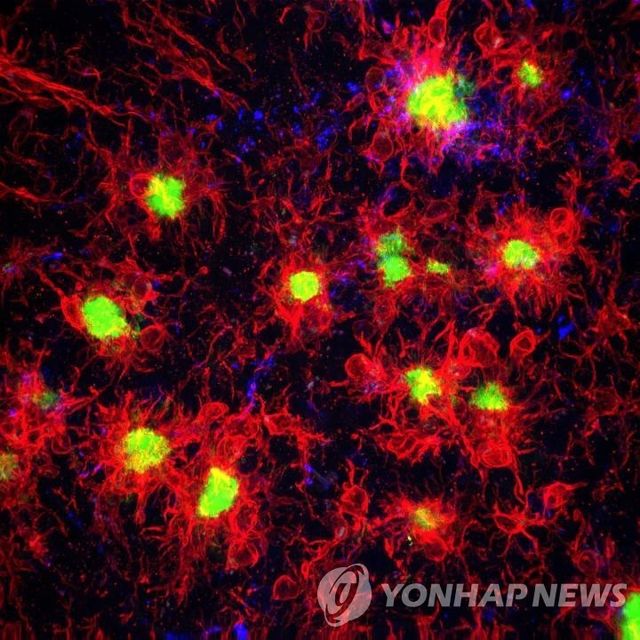 알츠하이머 환자의 뇌에서 플라크(녹색)를 공격하는 미세아교세포(붉은색)