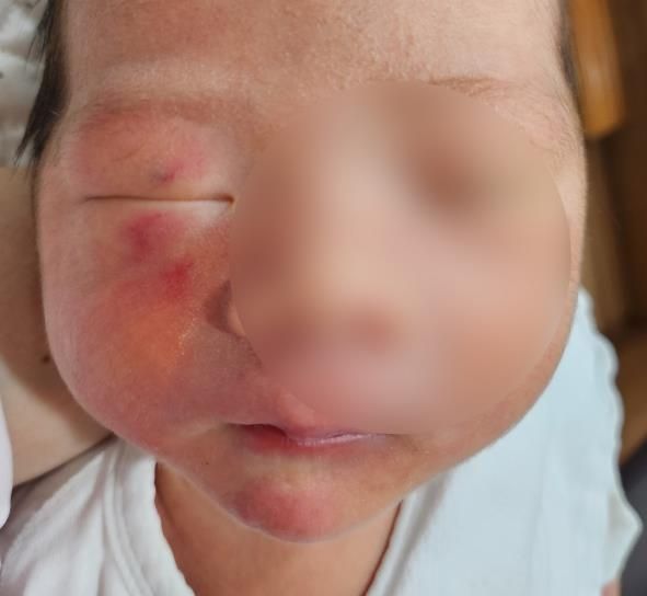 생후 4일 된 영아 얼굴에 상처