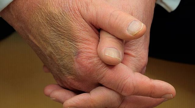 트럼프 미국 대통령 오른쪽 손등의 멍자국