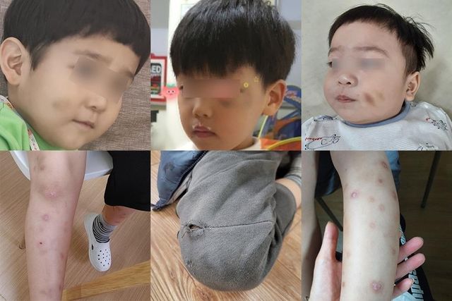 부모로부터 분리돼 보호시설에 가서 멍이 든 아이들 