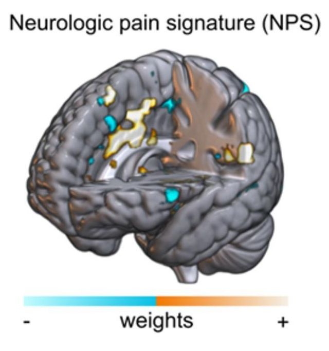 통증에 대한 뇌 반응 이미지