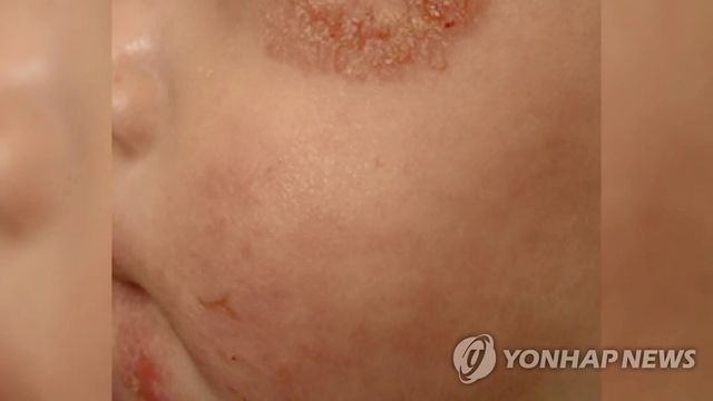 아토피 피부염