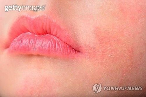 아토피성 피부염. [게티이미지뱅크 제공]
