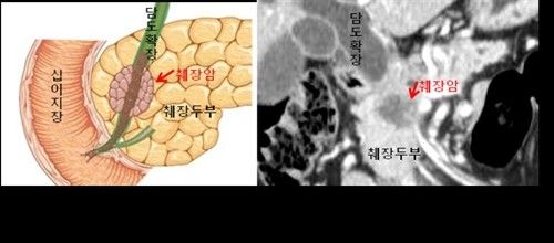 췌장암 CT 영상